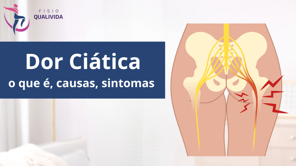 dor ciática ou ciatalgia