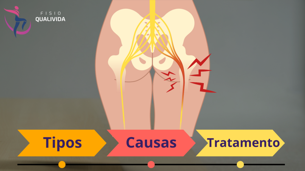 nervo ciático