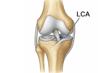 Lesão LCA: o que é e por que atletas precisam de cirurgia?